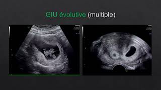 Échographie des grossesses précoces : intra-utérines et de localisations indéterminées (1ère partie)