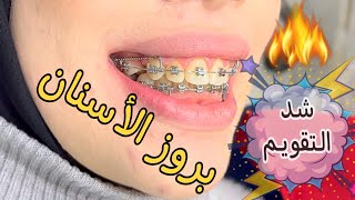 علاج بروز الأسنان {ضب الأسنان} #dr_eslam_nabil #teeth #dentist #braces #comedy #تقويم #طبيب_اسنان