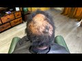 From Extreme thinning and balding to head full of hair | Alopecia extensions