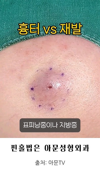 흉터 Vs 재발 (피지 멍울 압출 핀홀법 피지낭종 표피낭종 지방종 수술 아문성형외과 병원 Epidermal Cyst Lipoma ...