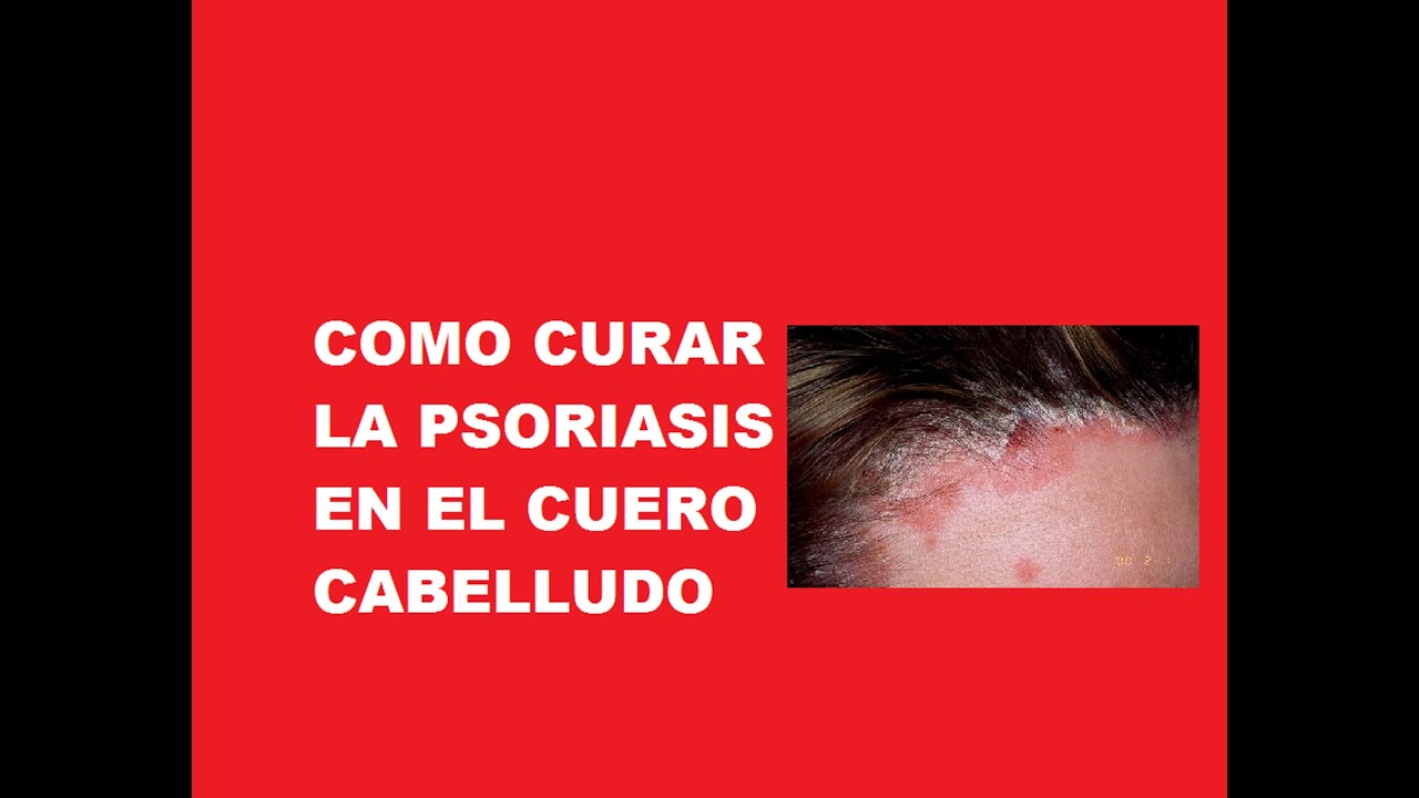 Cómo tratar la psoriasis del cuero cabelludo Cómo tratar la psoriasis del cuero cabelludo