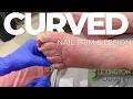 Curling Nail Clipping