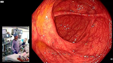 The Potential of AI in Endoscopy: Enhancing Polyp Detection