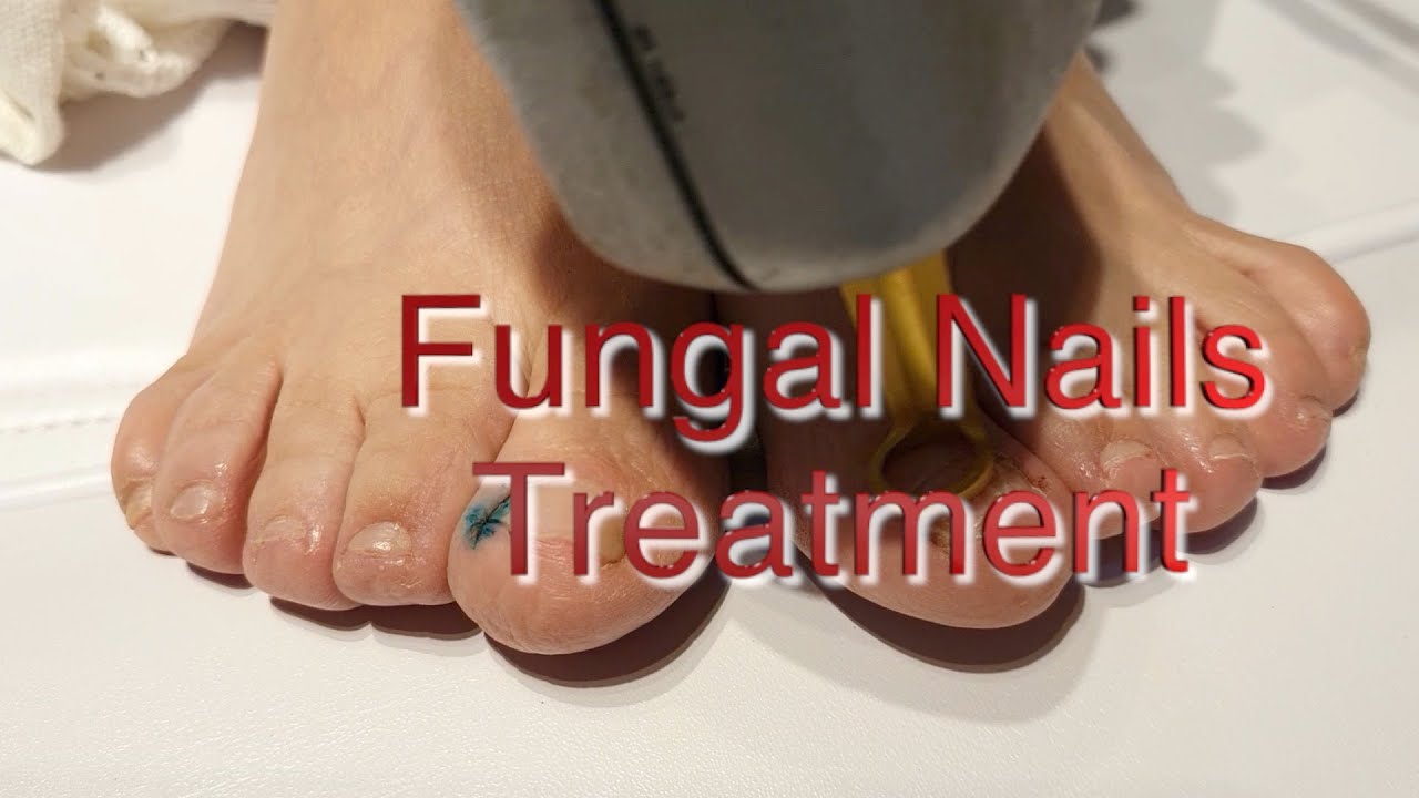 FUNGAL NAIL INFECTION TREATMENT YouTube