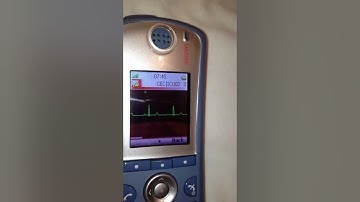 Ascom Alarm Escalation with Waveform