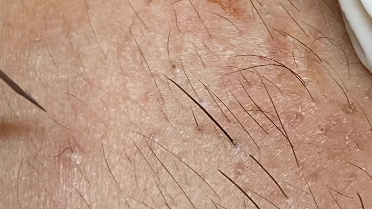 Squeeze Blackheads, Whiteheads | Nặn Mụn Đầu Đen, Mụn Ẩn Hấp Dẫn - SacDepSpa#107