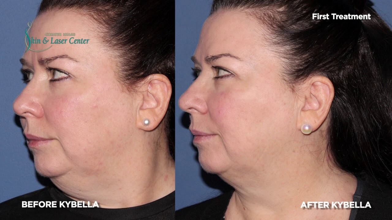Patient Testimonial on Kybella for Double Chin - YouTube