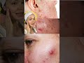 👀 Not all acne is the same — do you know which one you have?