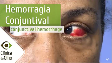 O que é bom para coágulo de sangue no olho?