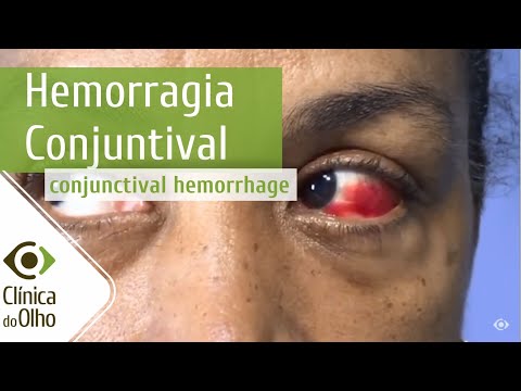 Vídeo: Sangramento Nos Olhos