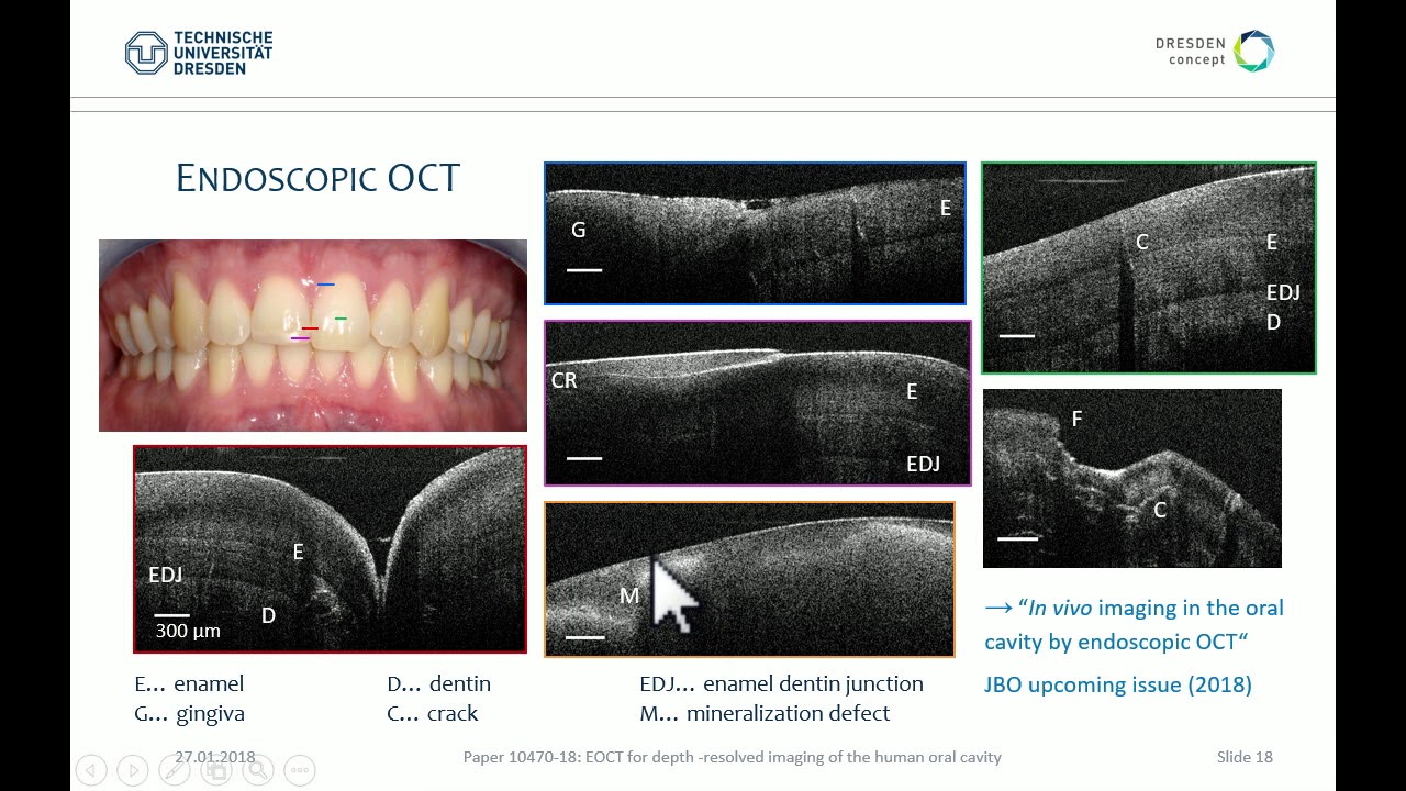 Julia Walther Optical coherence tomography in the oral cavity YouTube