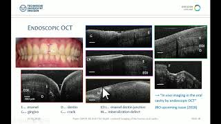 Julia Walther: Optical coherence tomography in the oral cavity