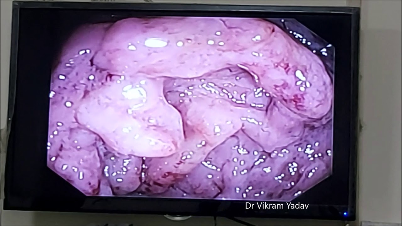 Sigmoidoscopy & Taking Biopsy From Sigmoid Colon - YouTube