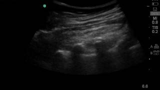 Ultrasound guided thoracic paravertebral block.