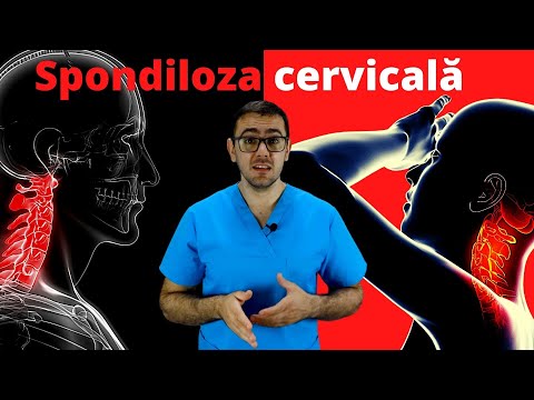 Video: 3 moduri de a trata spondiloza