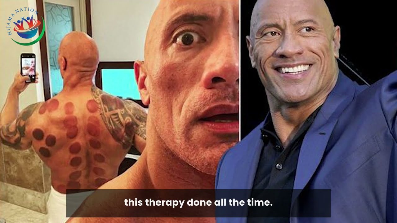 Discover Hijama Cupping Therapy | Transformative Wellness in Under 3 Months!