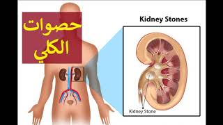 حصوات الكلي