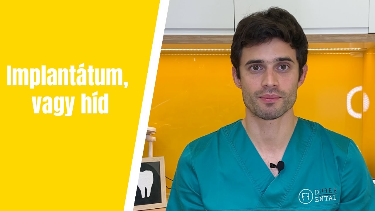 Hiányzó fog pótlása: Implantátum vagy híd?