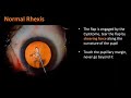 Pcr from improper capsulorhexis pscs cataractsurgerytipsforbeginners