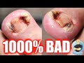 INSANE OVERGROWN INFECTED TOENAIL REMOVAL