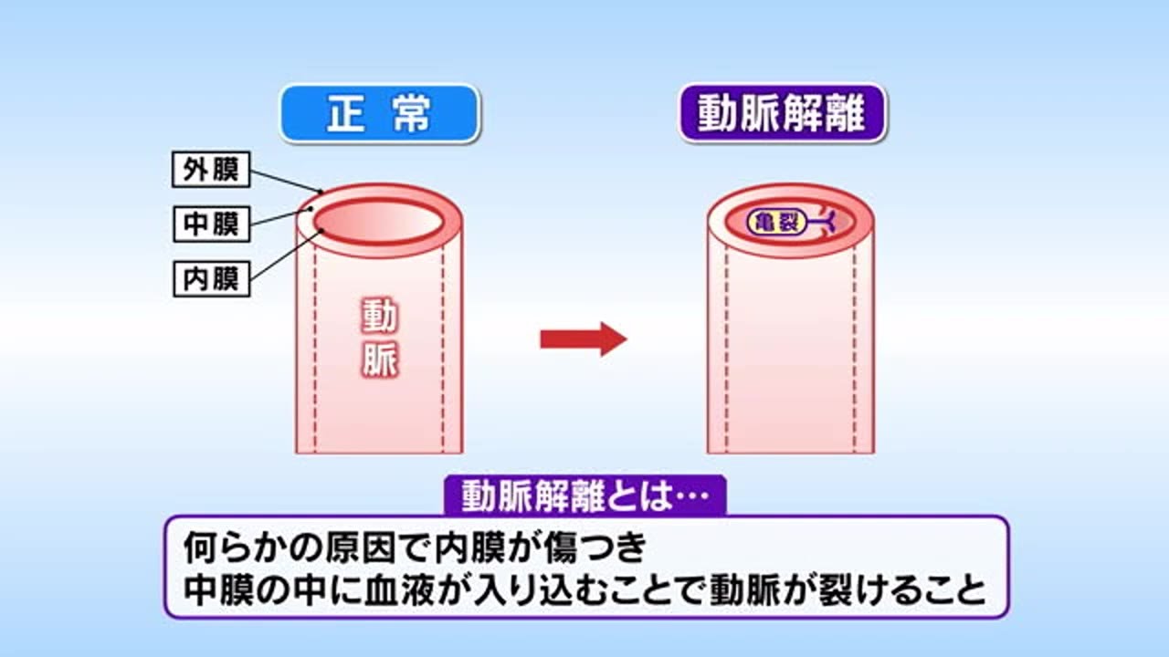 元気○（マル）らいふ　【危険な頭痛「椎骨動脈解離」】（2023/4/12放送　ニュースプラス１いわて）