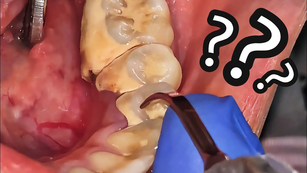 Calculus Removal on Teeth | Dokter Gigi Tri Putra - YouTube