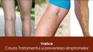 primele semne de varicoză și tratamentul său cum să vă ajutați picioarele în varicoză