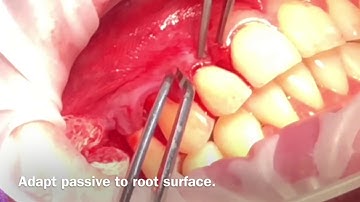 Recession Coverage with  CAF and Ossix Volumax Membrane. By Dr.Orawan Kulkliang,D.D.S.