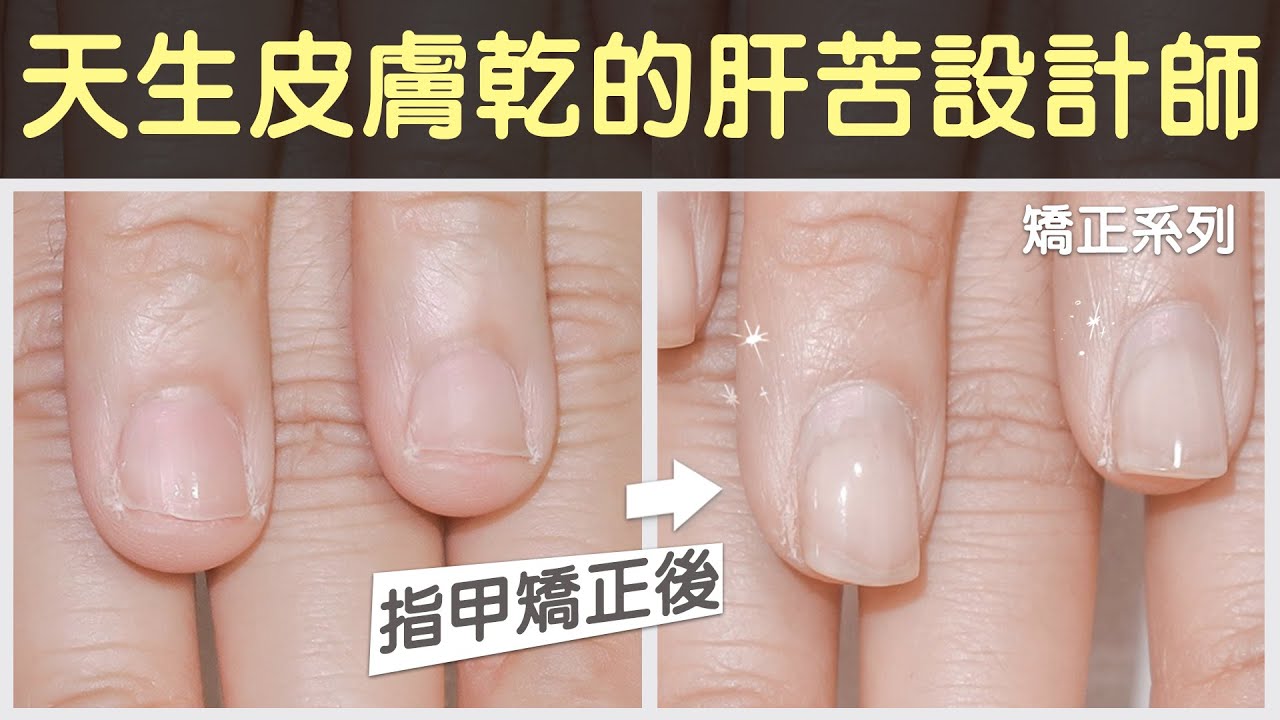 亞瑟認真搞笑介紹 天生皮膚乾又咬指甲 設計師的71週矯正 處理甲床外露 指肉外露 指甲太短的困擾 Youtube
