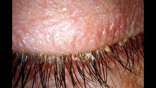 Blepharitis - How to tell if your EyeLid Demodex treament is working