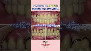 치과 공포의 끝, 임플란트 수술 완벽 가이드!🧐 #임플란트 #틀니 #미백 #임플란트관리 #임플란트비용 #임플란트수술 #치과 #디지털치과 #치통 #서울룬치과