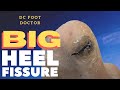 Big Heel Fissure: A Deep Crack in the Heel