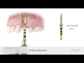 Xive  drilling sequence and implant placement  dentsply sirona