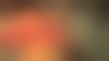 Iliac crest flap based on DCIA  Mohit Sharma