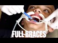 GETTING BRACES FOR THE FIRST TIME FOR THE SECOND TIME | TOP AND BOTTOM BRACES PUT ON AGAIN