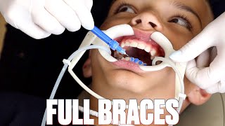 GETTING BRACES FOR THE FIRST TIME FOR THE SECOND TIME | TOP AND BOTTOM BRACES PUT ON AGAIN