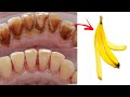 The secret that dentists don&#39;t want you to know: Removes tartar and whitens teeth in 2 minutes