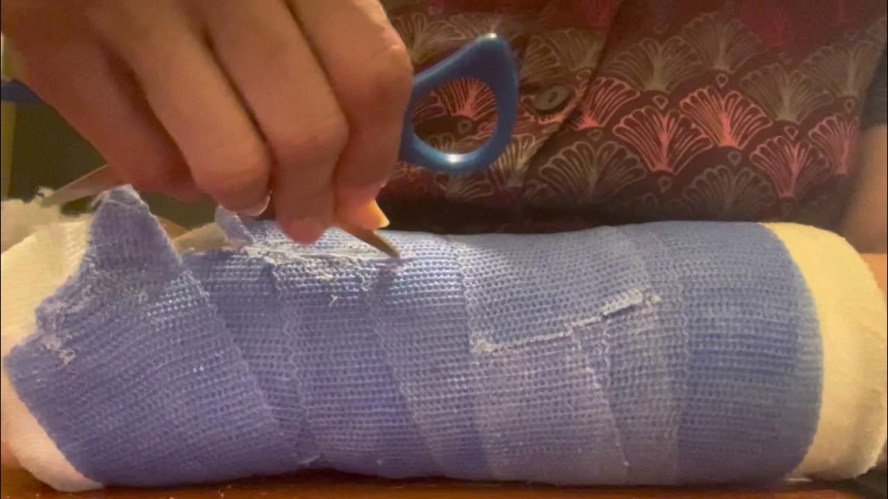 How to remove a cast at home part 2 YouTube