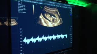 Hi Mom Ultrasounds   Baby's Heartbeat