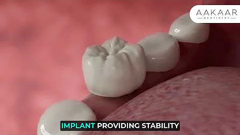 Step by Step Guide to Your Dental Implant Procedure | Aakaar Dentistry
