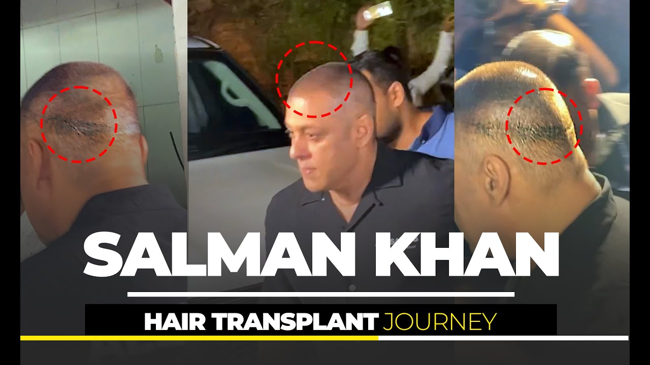 DrKhans exclusive hair transplant center in Hyderabad India  Read 5  Reviews