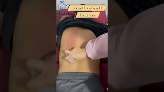 ودع الالام تيبس العضلات مع الحجامه الجافه #الحجامة  #الحجامه_الجافه   #العلاج_الطبيعي