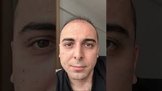 Saç Ekimi Sonrası 100.Gün Çekimi Ç