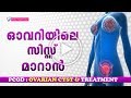 Ref:b_7-WkDAy1s Ovarian cyst symptoms &amp; ovarian cyst treatment in malayalam | dr bindu | ethnic health court
