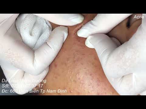 Video Trị mụn trứng cá nhanh chóng chi phí rẻ, an toàn mà... - youtube