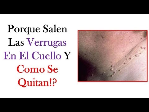 porque salen verrugas porque salen las verrugas en el cuello y como se quitan porque salen verrugas porque salen las verrugas en el cuello y como se quitan