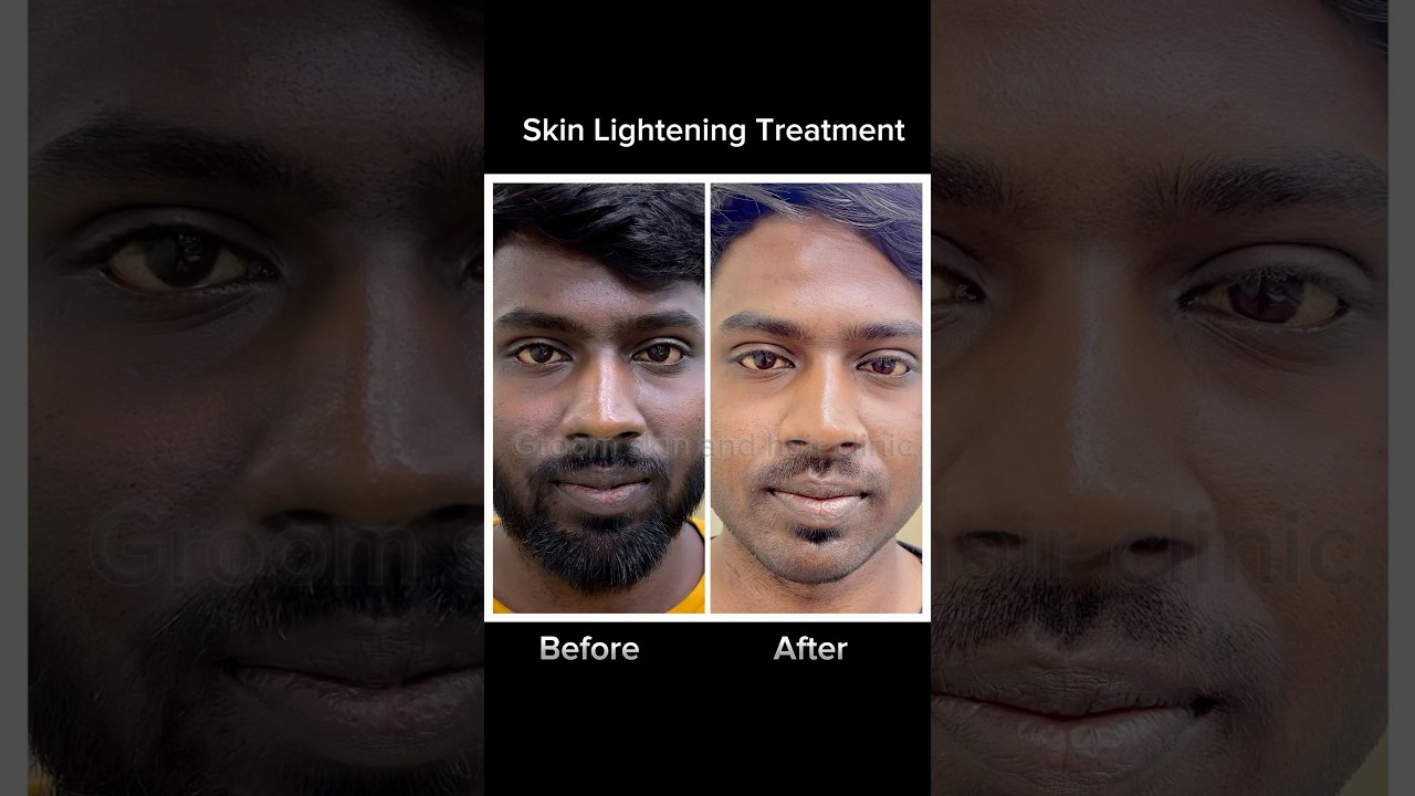 Skin Lightening Treatment | Before After Transformation 🔥🔥🔥 #music