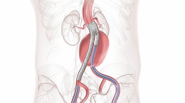 ANIMATION - GORE® EXCLUDER® AAA ENDOPROSTHESIS