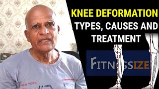 Knee deformation : Types, Causes and Treatment | Explained | fitnessize