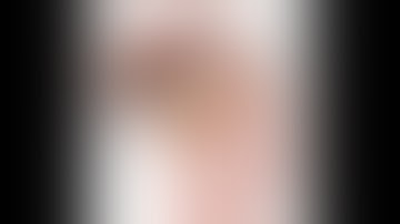 EUS directed transgastric ERCP in patient with Roux-en-Y gastric bypass & choledocholithiasis (EDGE)